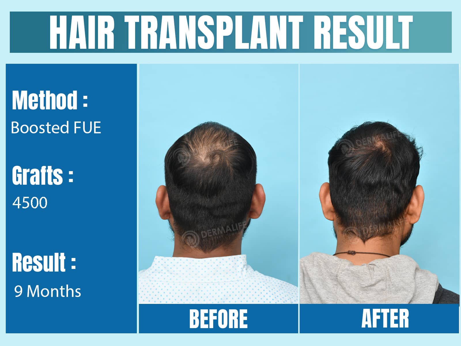 Before and After Results of Hair Transplant for Crown