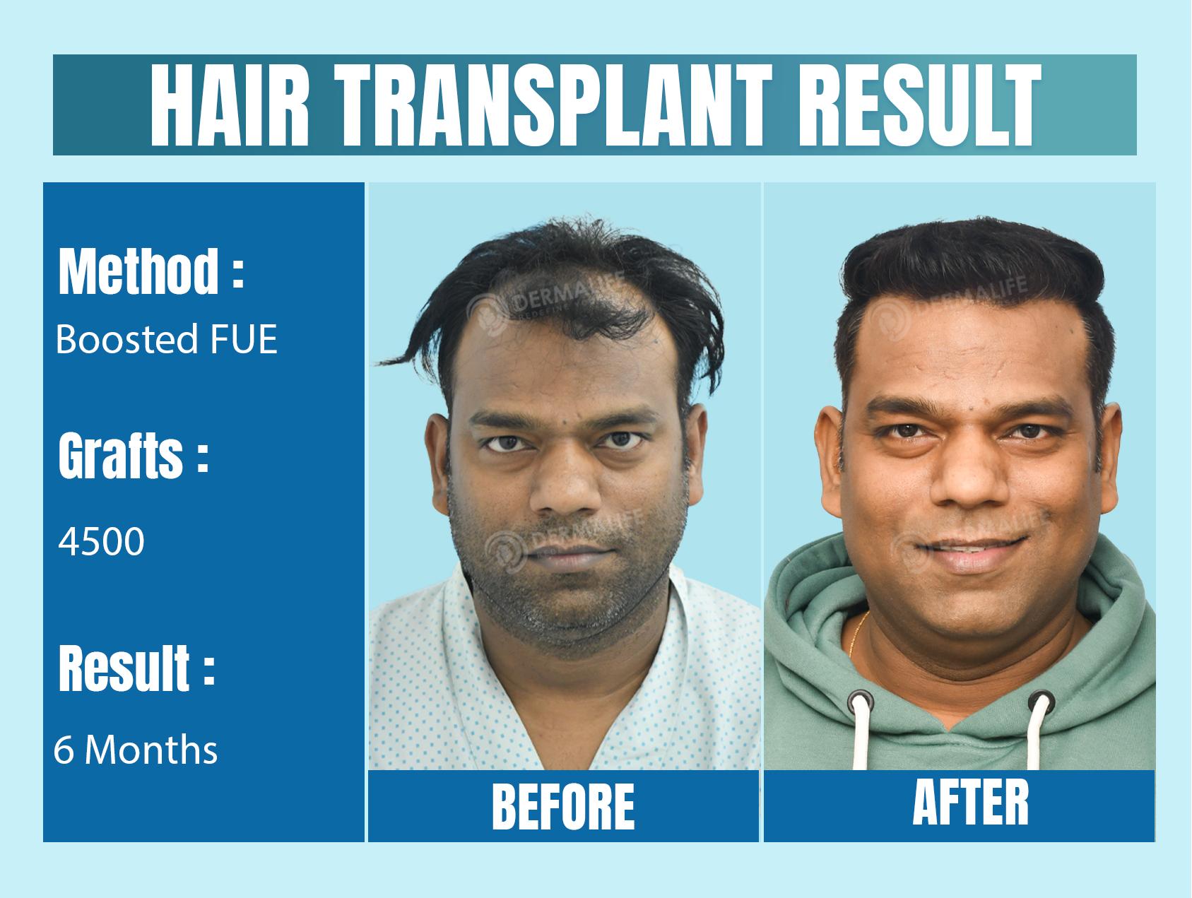 Hair Transplant Before After Result with 4500 Grafts