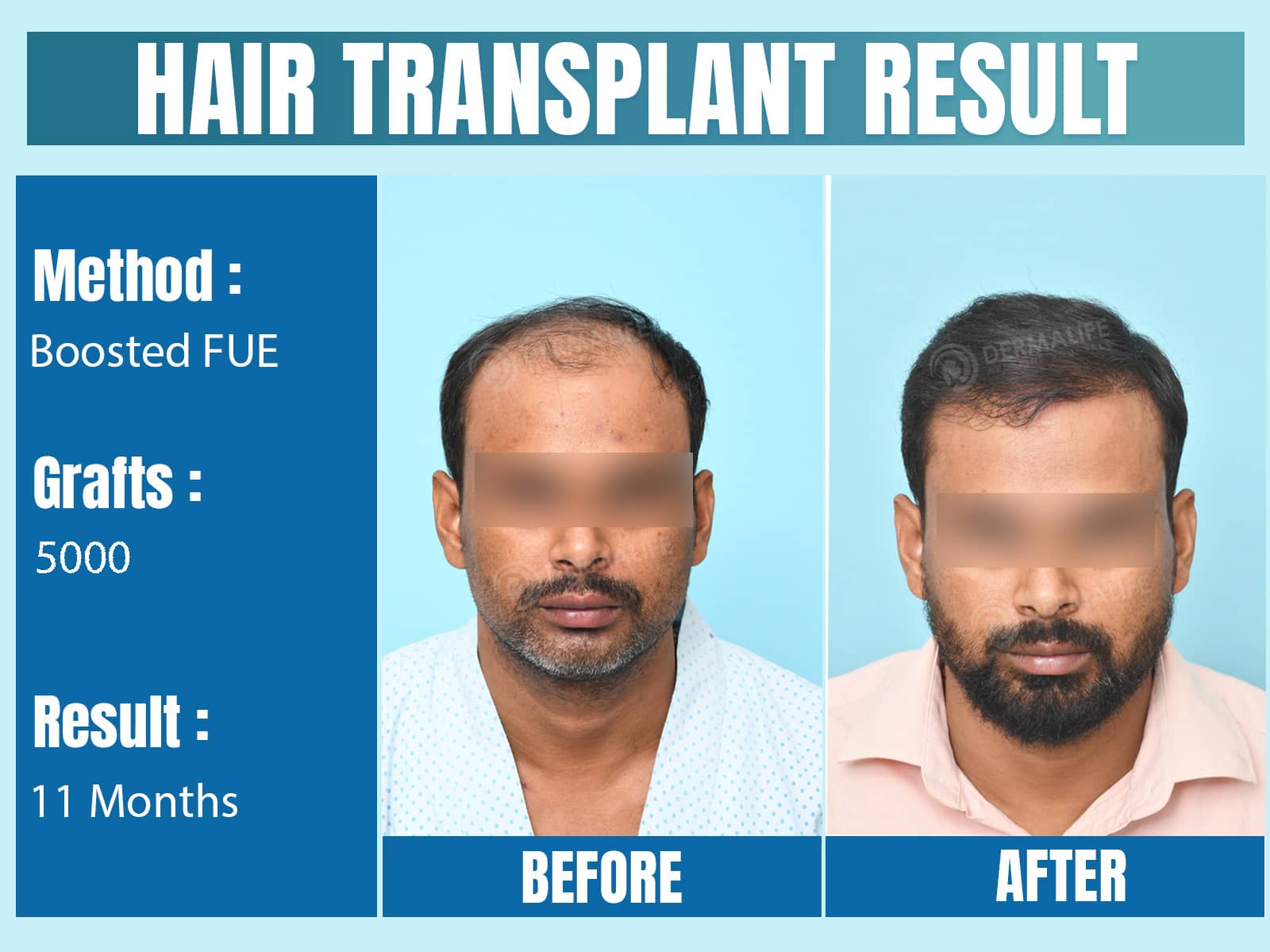 Before and After Results of Hair Transplant for Norwood Grade 5