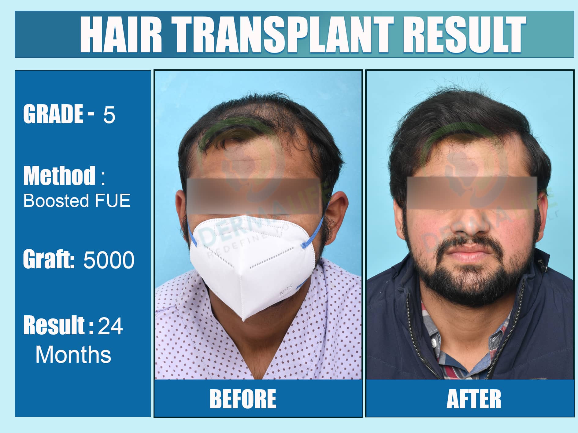 Before and After Results of Hair Transplant for Norwood Grade 5