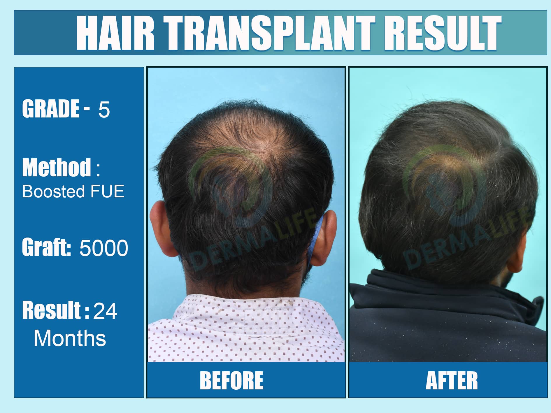 Before and After Results of Hair Transplant for Crown