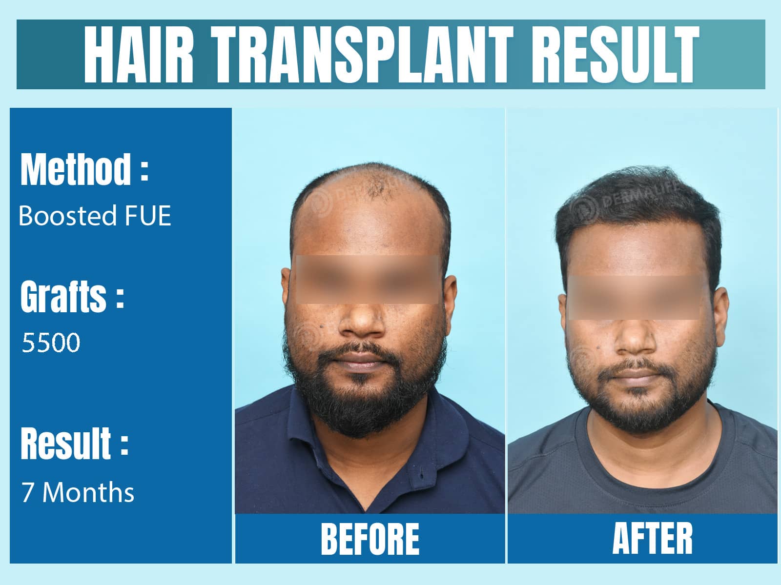 Before and After Results of Hair Transplant for Norwood Grade 5