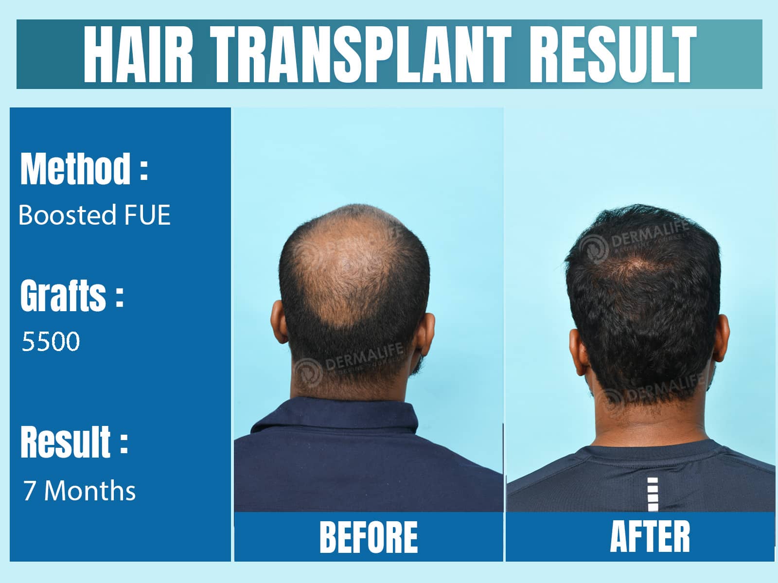 Before and After Results of Hair Transplant for Crown