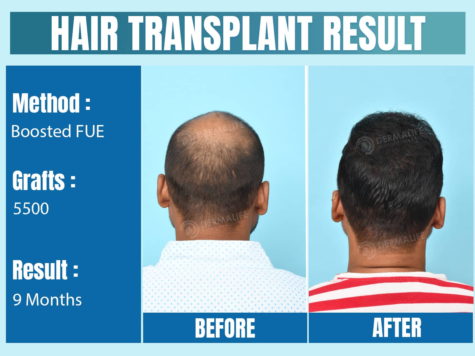 Before and After Results of Hair Transplant for Crown