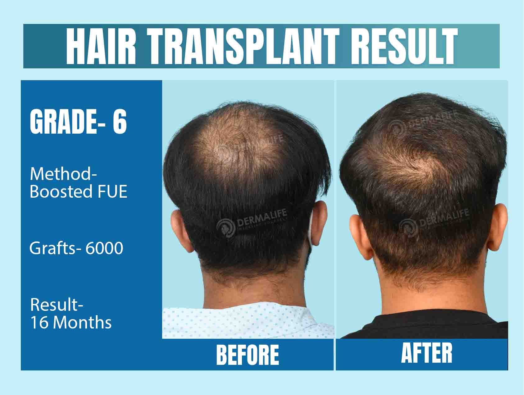 Hair Transplant Before and After Result 16 Month Grade 6 Baldness with 6000 Grafts