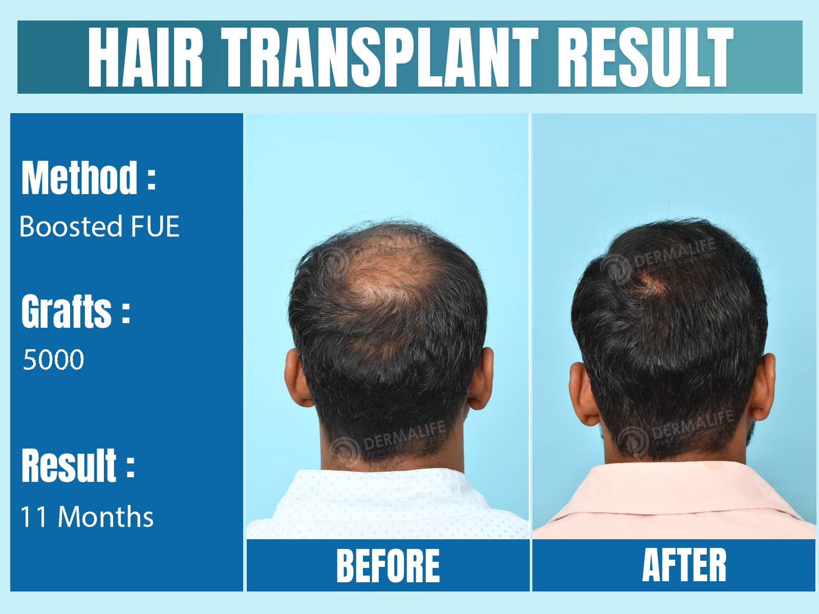 Before and After Results of Hair Transplant for Crown