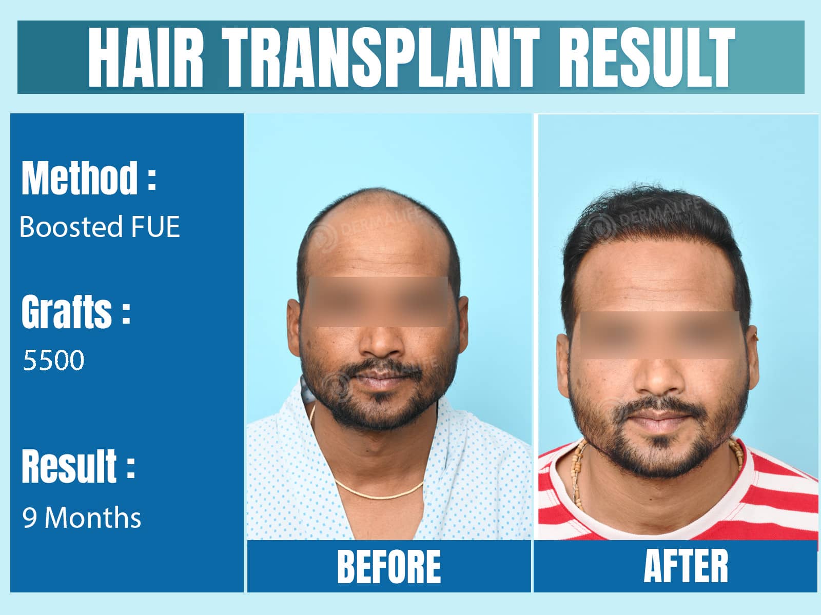 Before and After Results of Hair Transplant for Norwood Grade 5