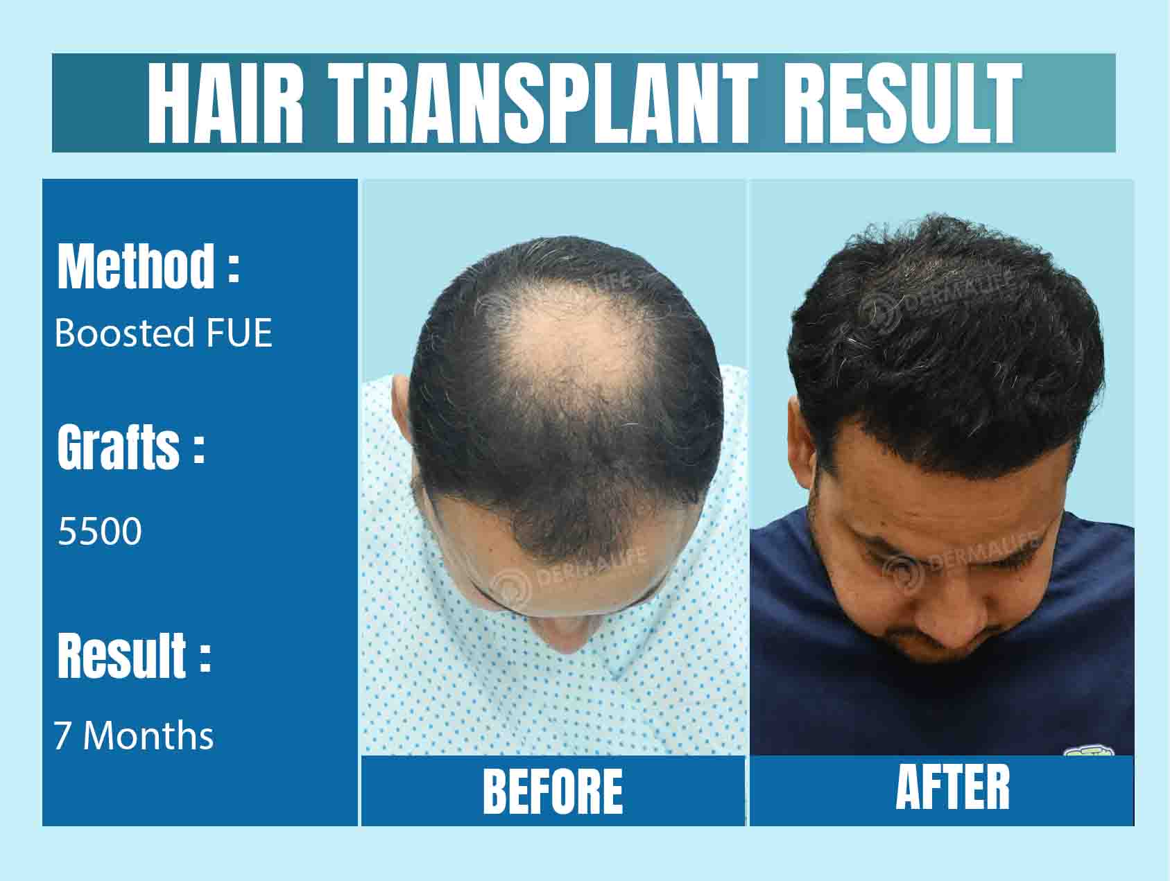 Hair Transplant Clinic in India