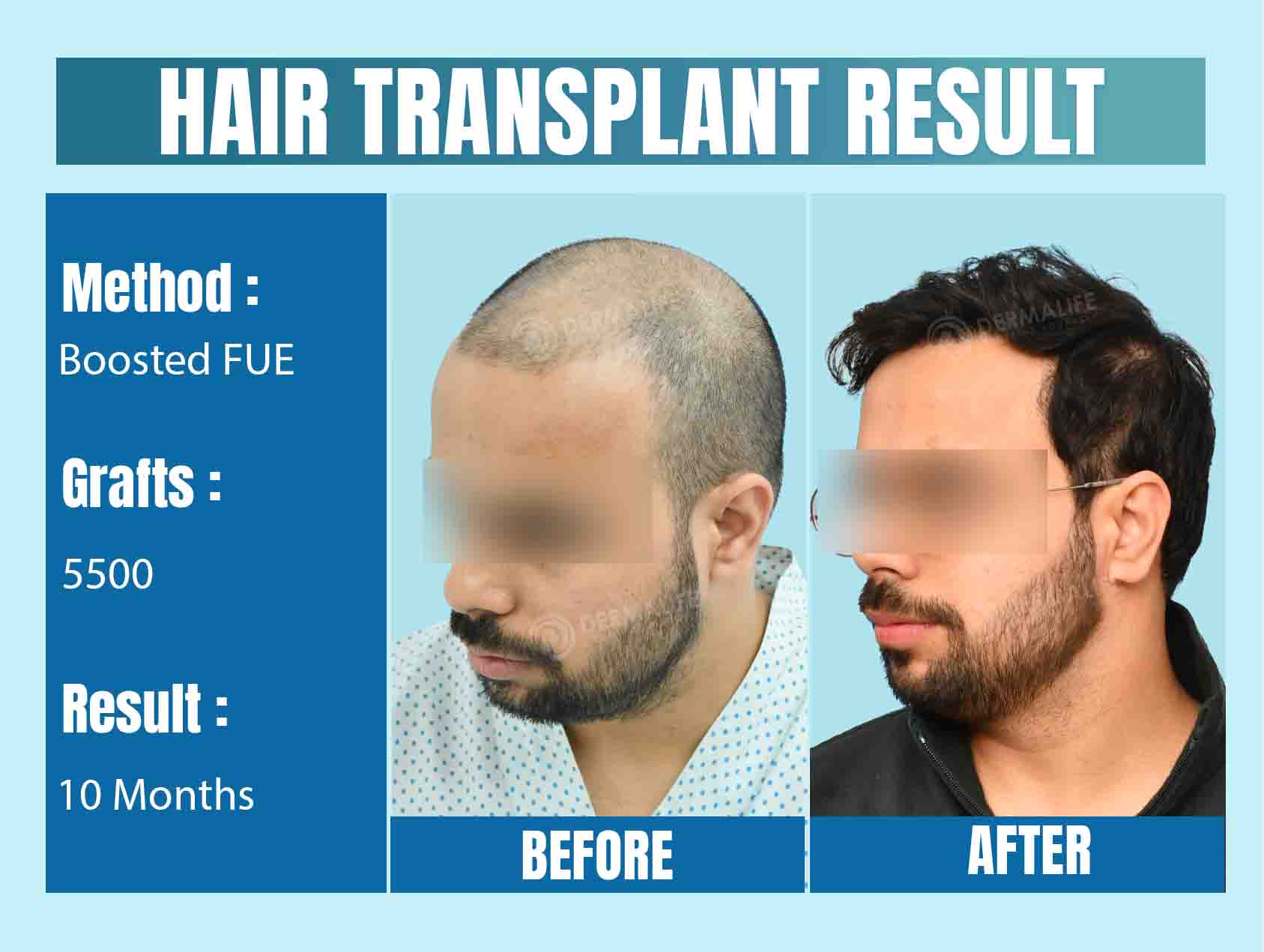 Best Hair Transplant Clinic in Delhi NCR, India