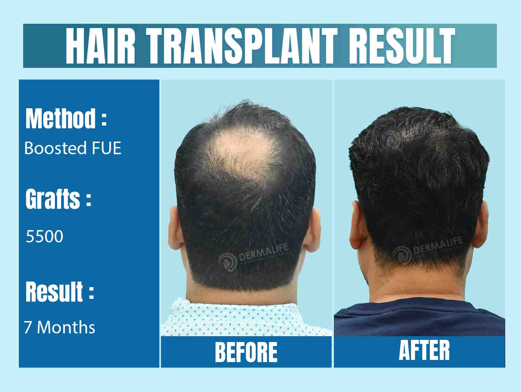 Hair Transplant Clinics in India