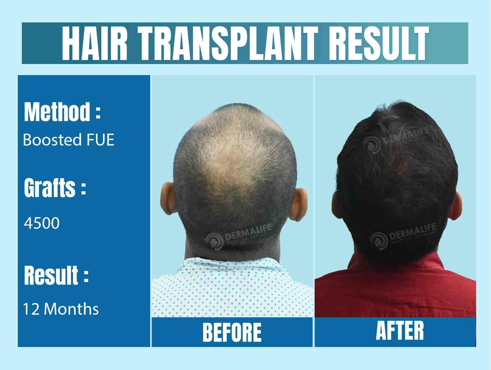 Top Hair Transplant Cost in Delhi NCR