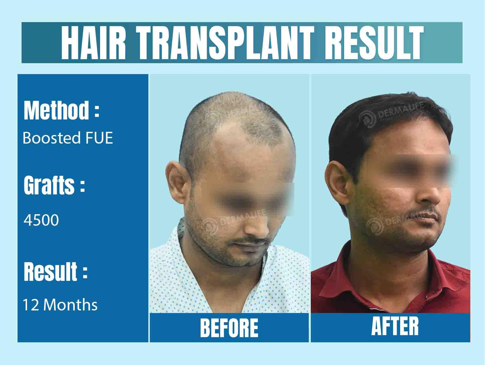 Top Hair Transplant Cost in Delhi NCR
