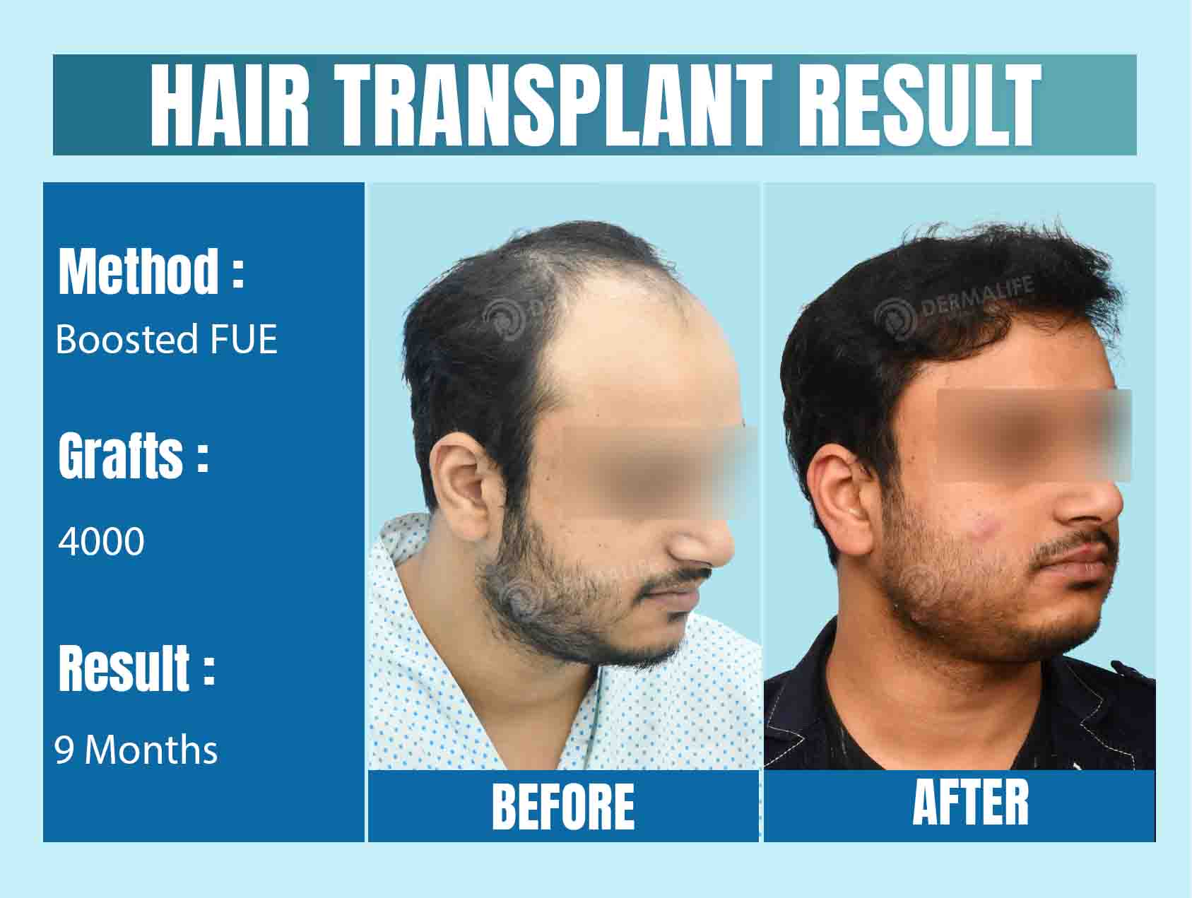 Hair Transplant Cost in Noida