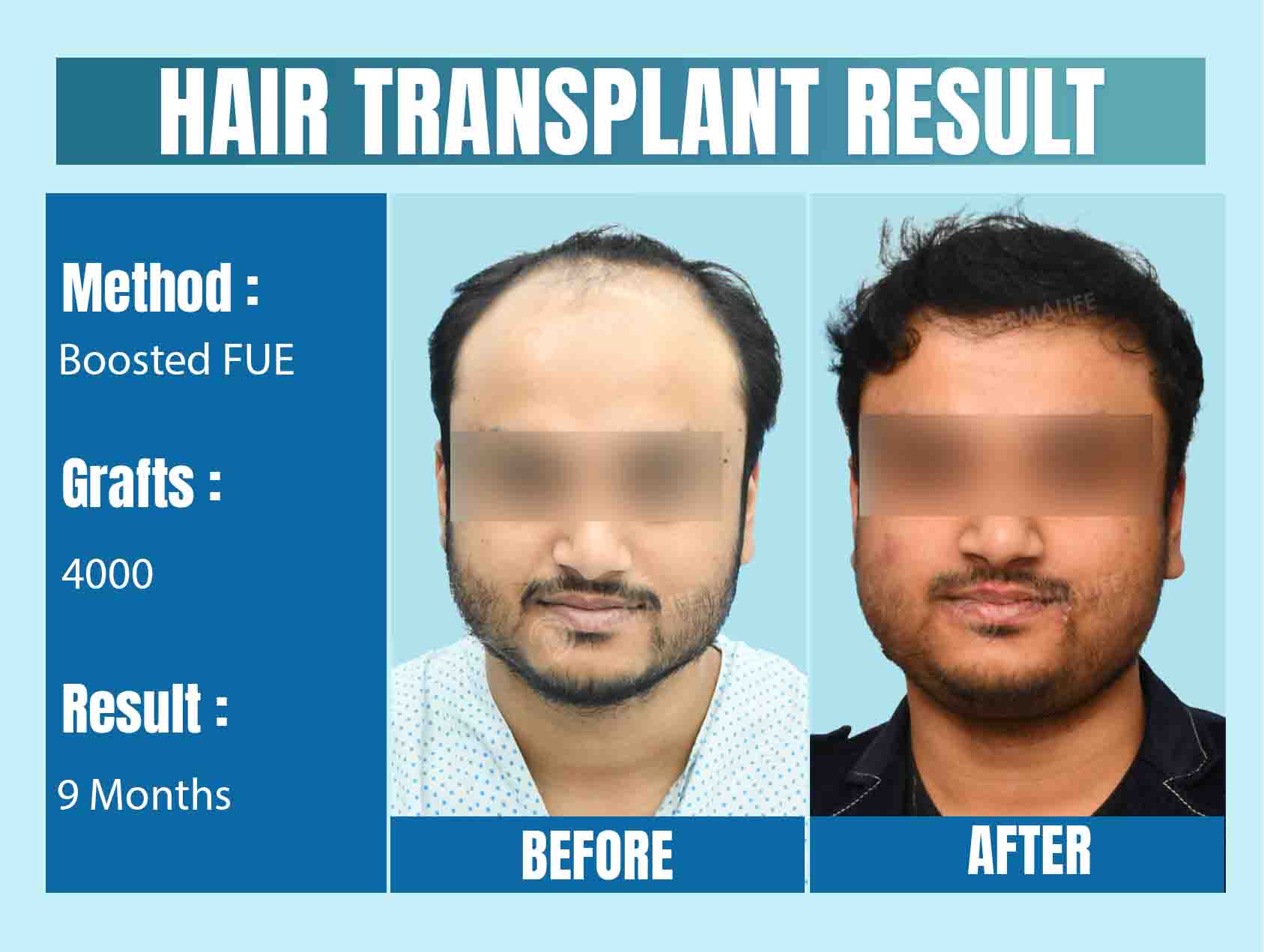 hair Transplant Before & After
