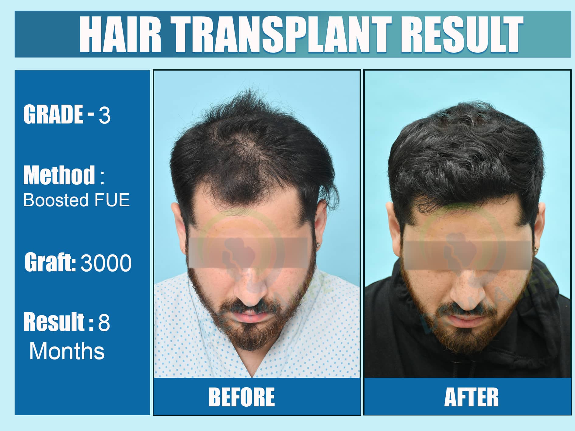 Before and After Results of Hair Transplant for Norwood Grade 3