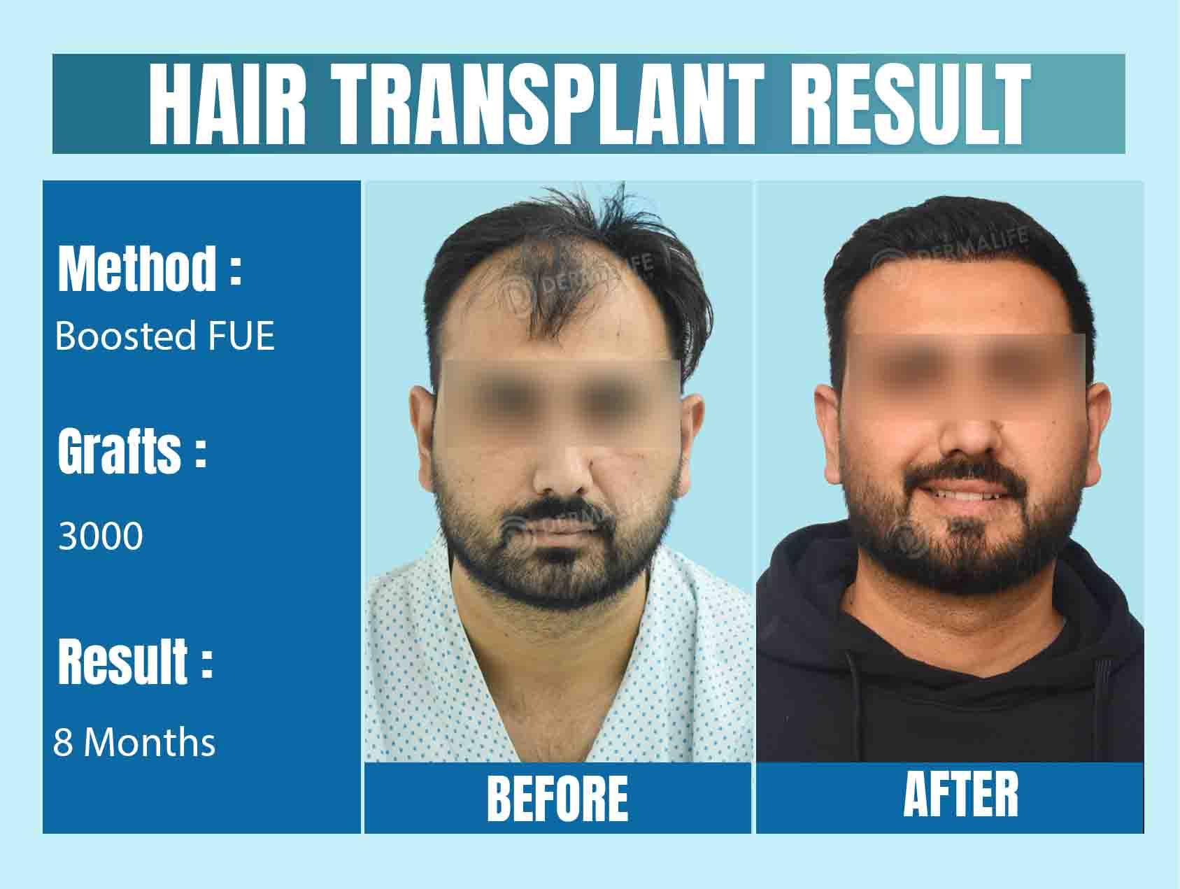 Best Hair Transplant Doctor in Delhi NCR