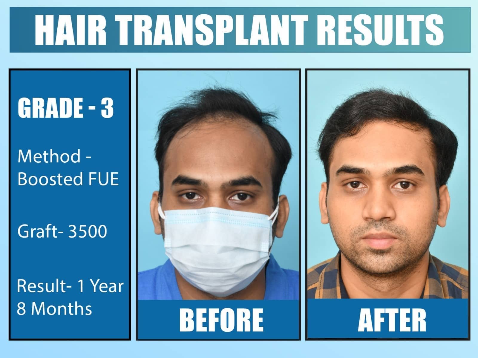 Before and After Results of Hair Transplant for Front