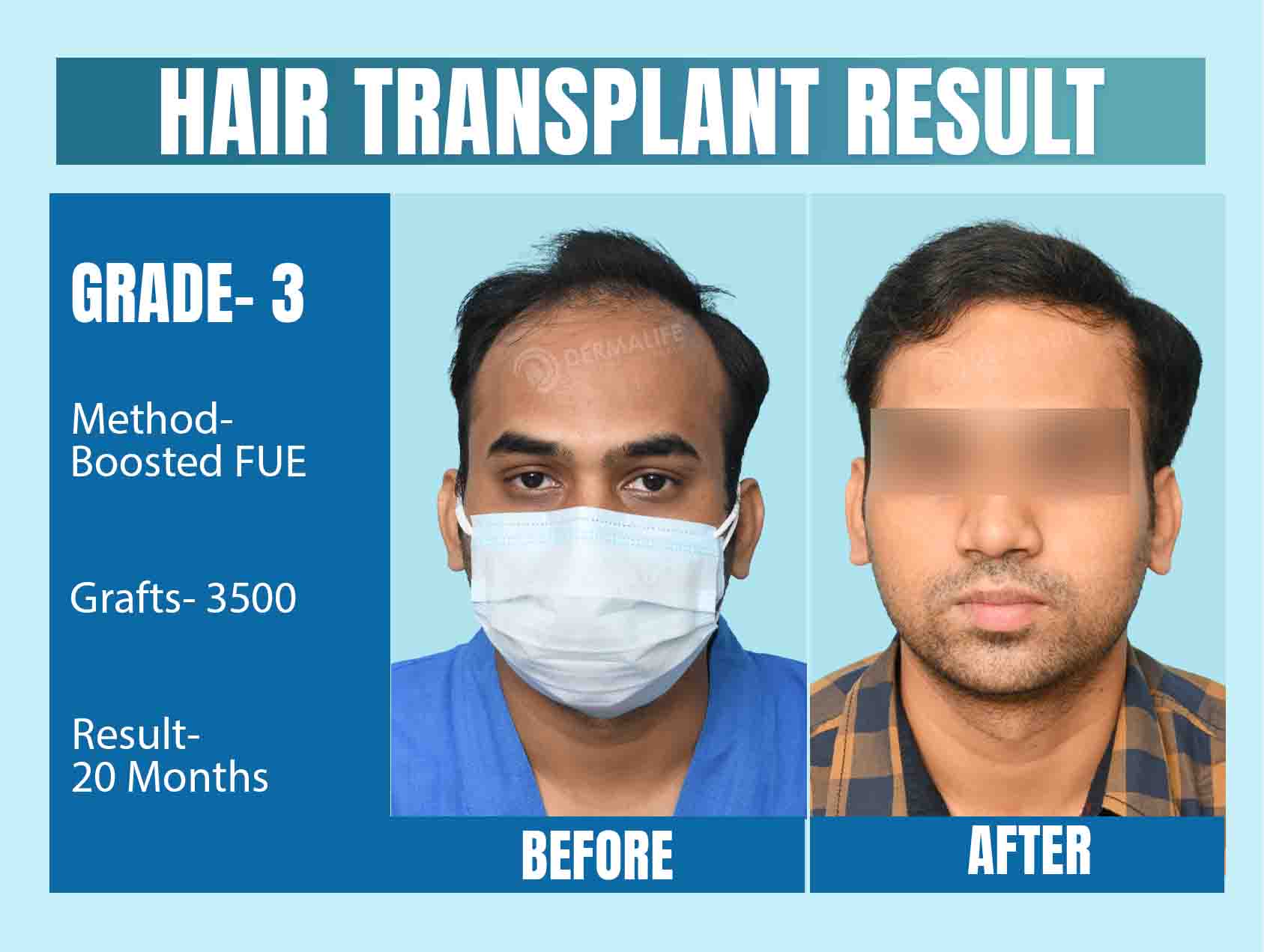 Hair Transplant Results After 20 Months