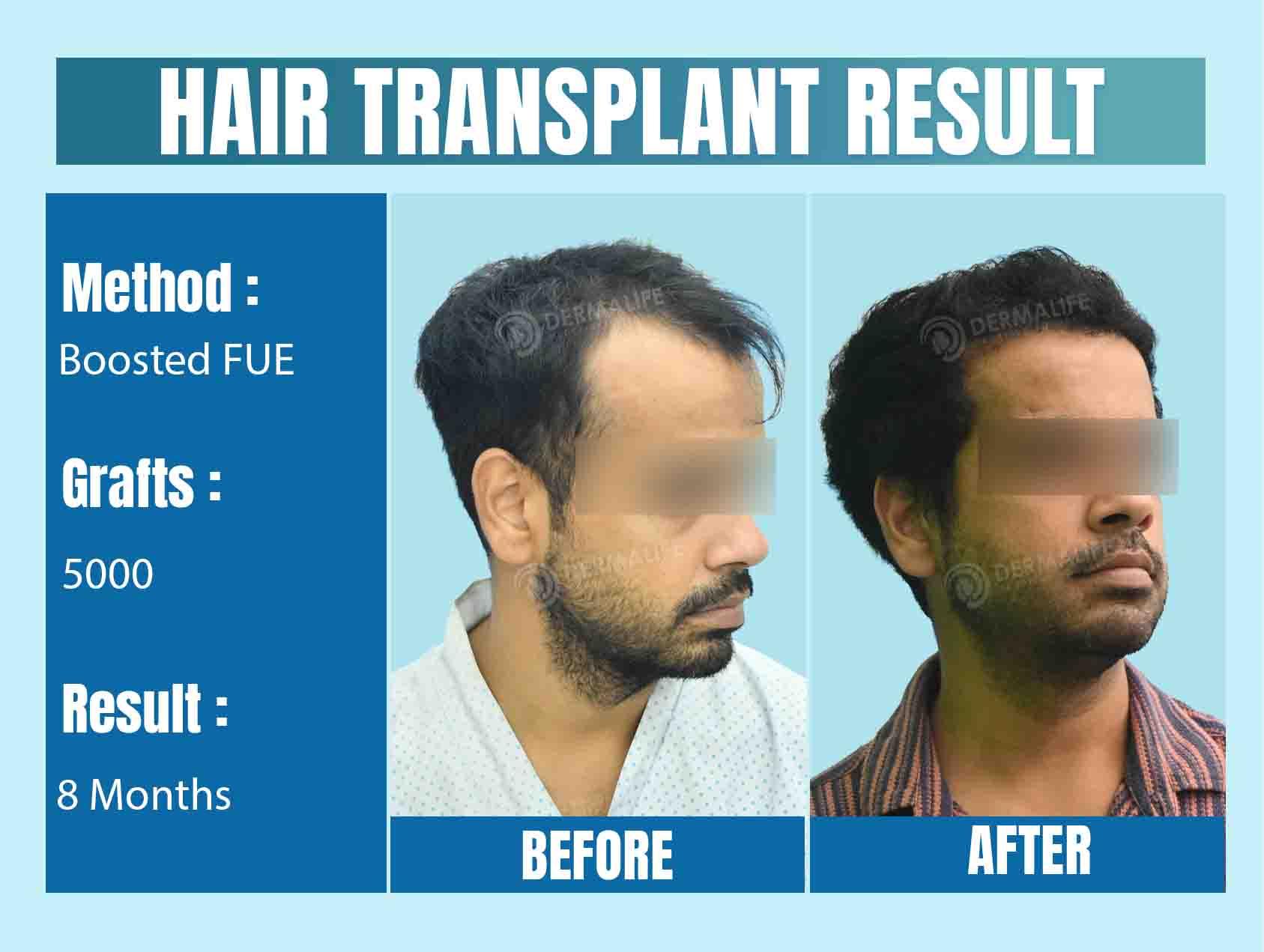 Best Hair Transplant Surgeon in Delhi NCR