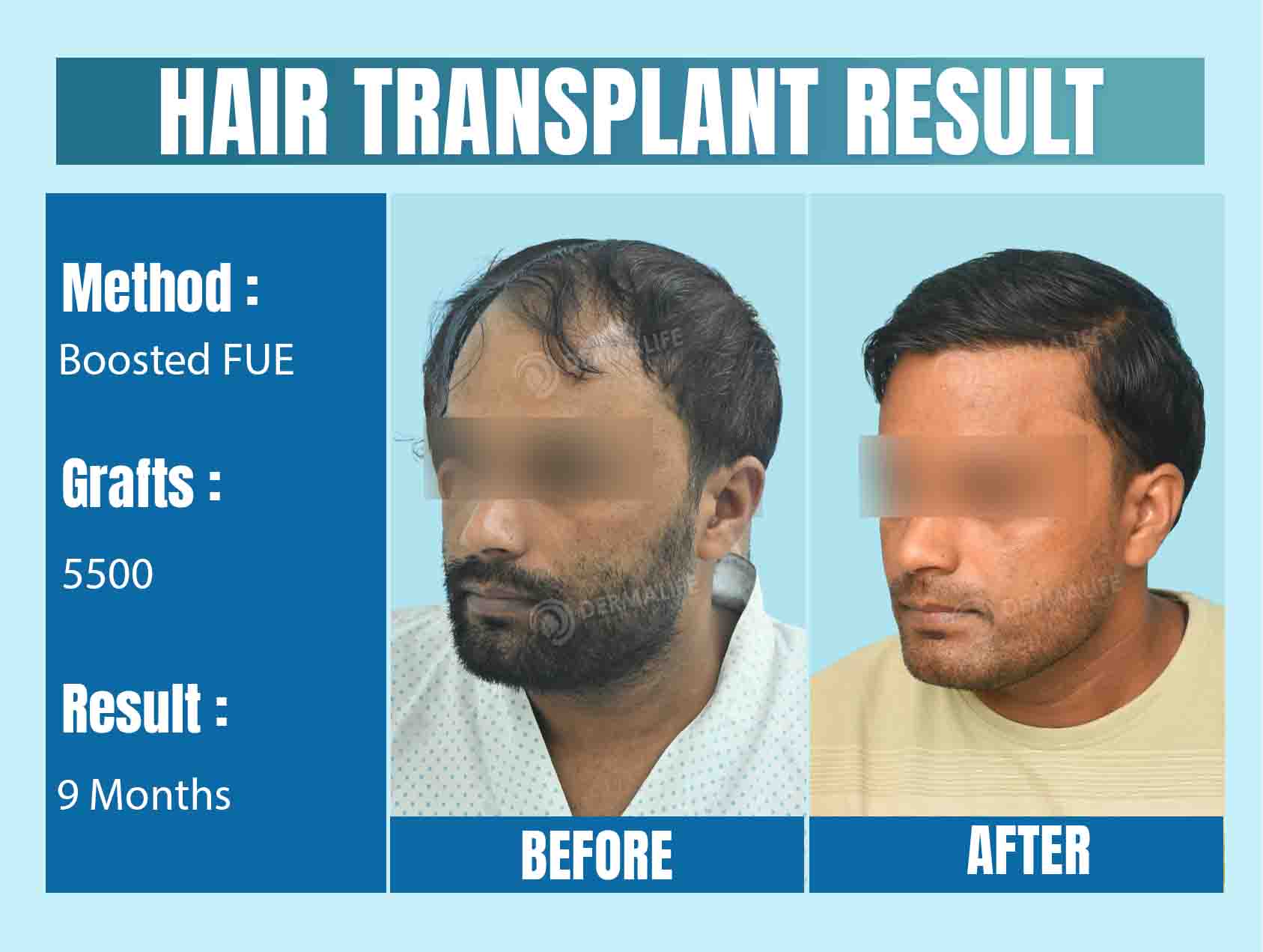 Hair Transplant in Delhi