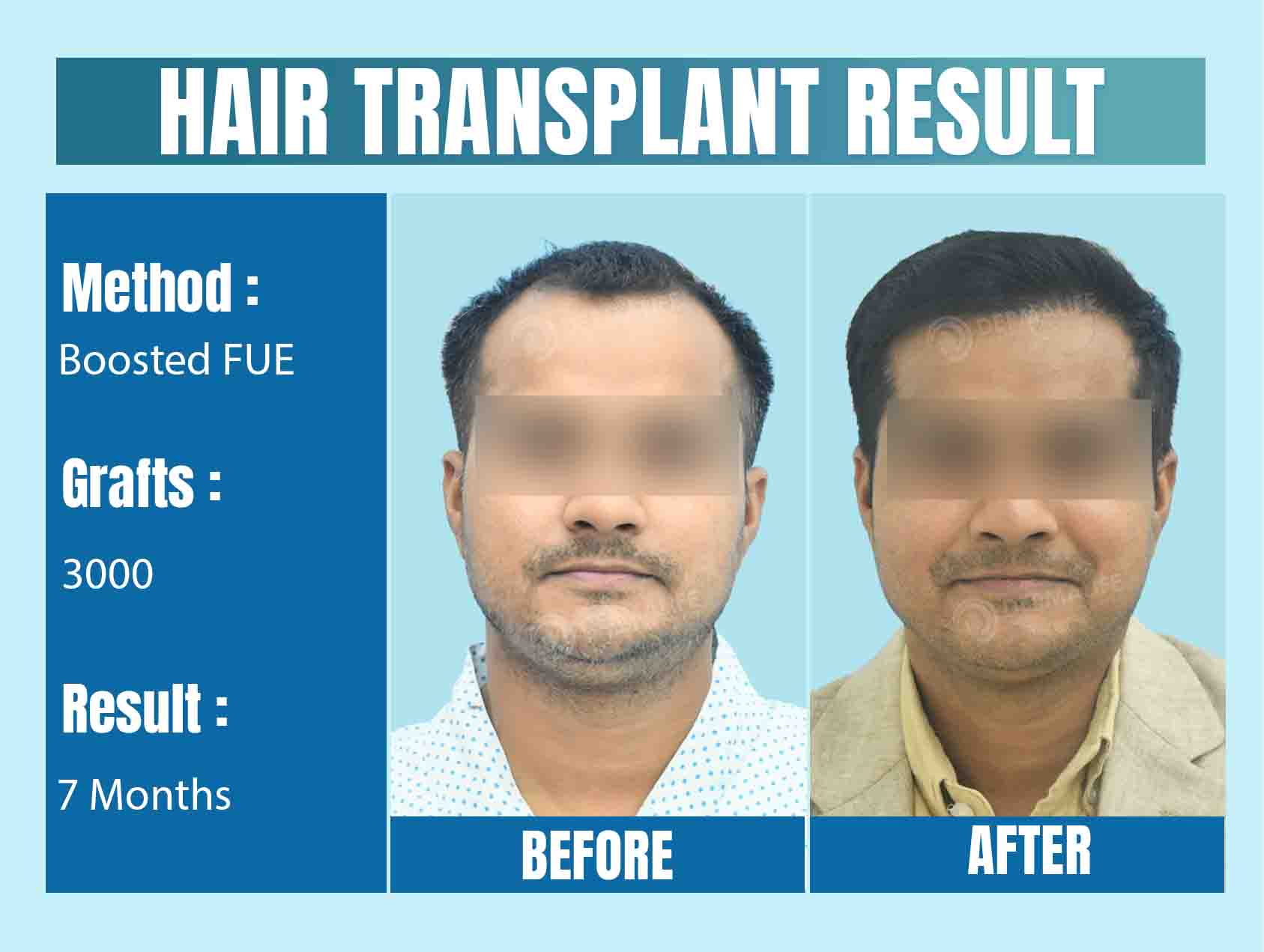 Hair Transplant in Delhi - Before and After Result
