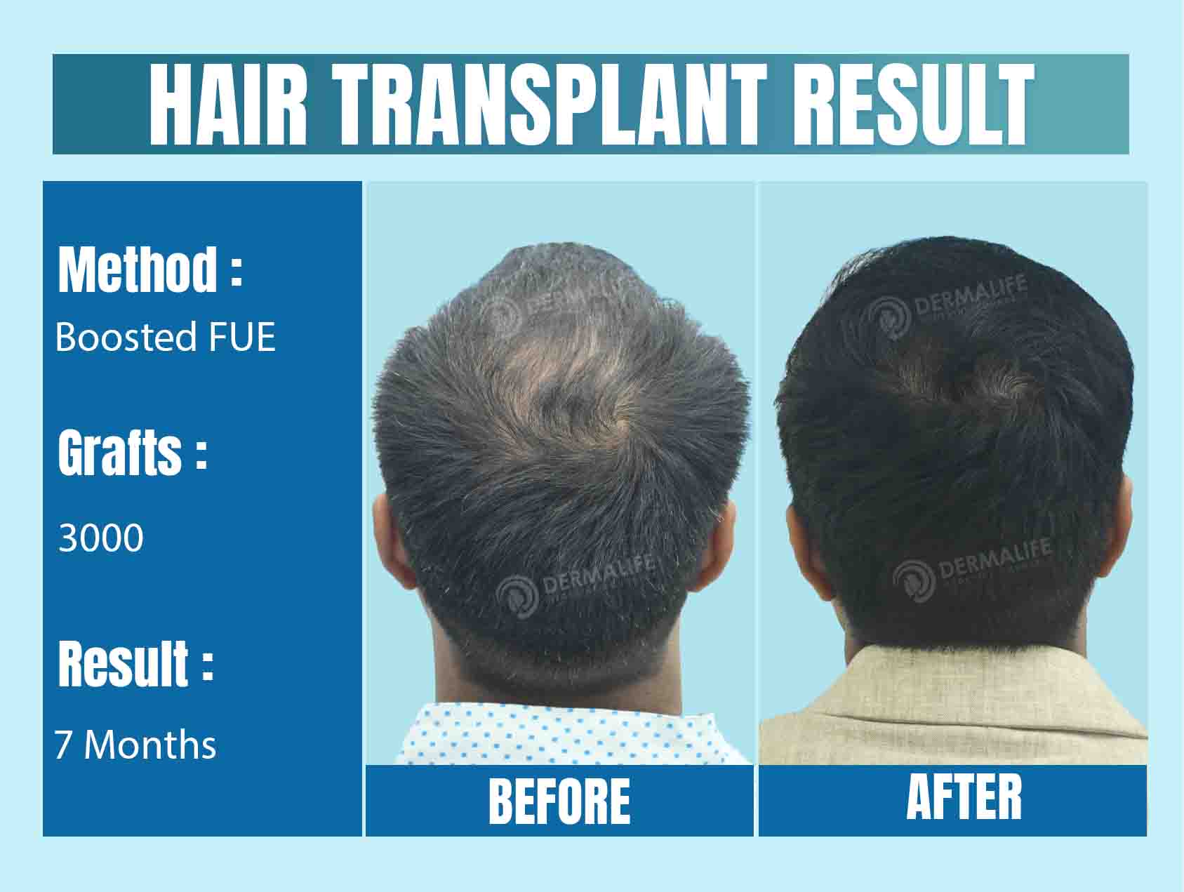 Hair Transplant in Delhi - Before and After Results