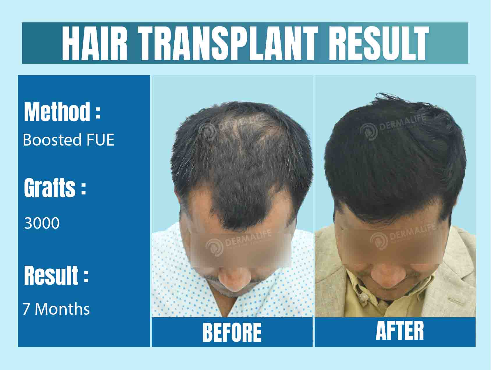 Hair Transplant in Delhi - Before and After Results