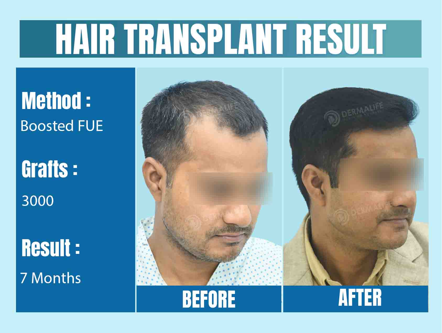 Hair Transplant in Delhi - Before and After Results