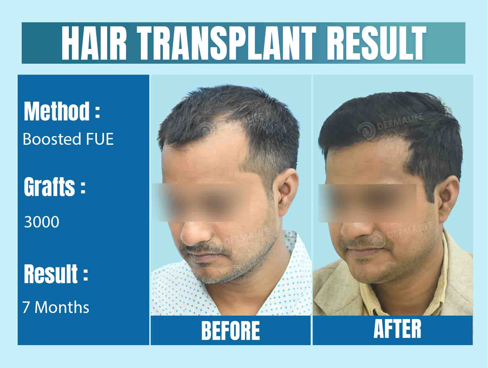 Hair Transplant in Delhi - Before and After Results