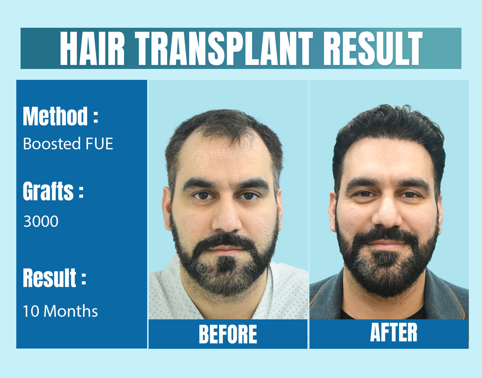 Hair Transplant with 3000 Grafts After 10 Months Result