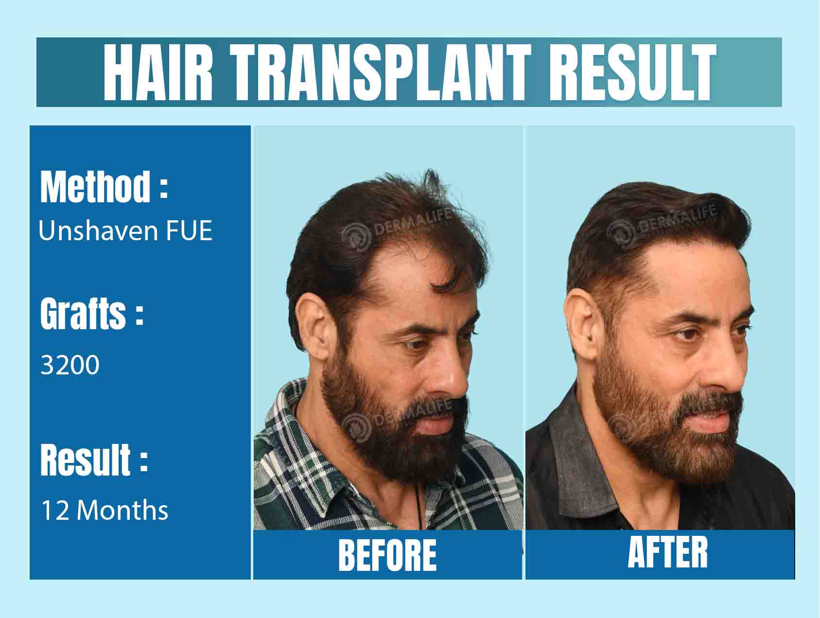 Long hair transplant in Delhi