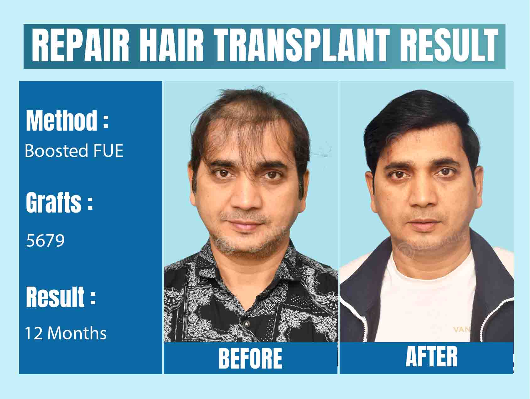 hair Transplant Before & After