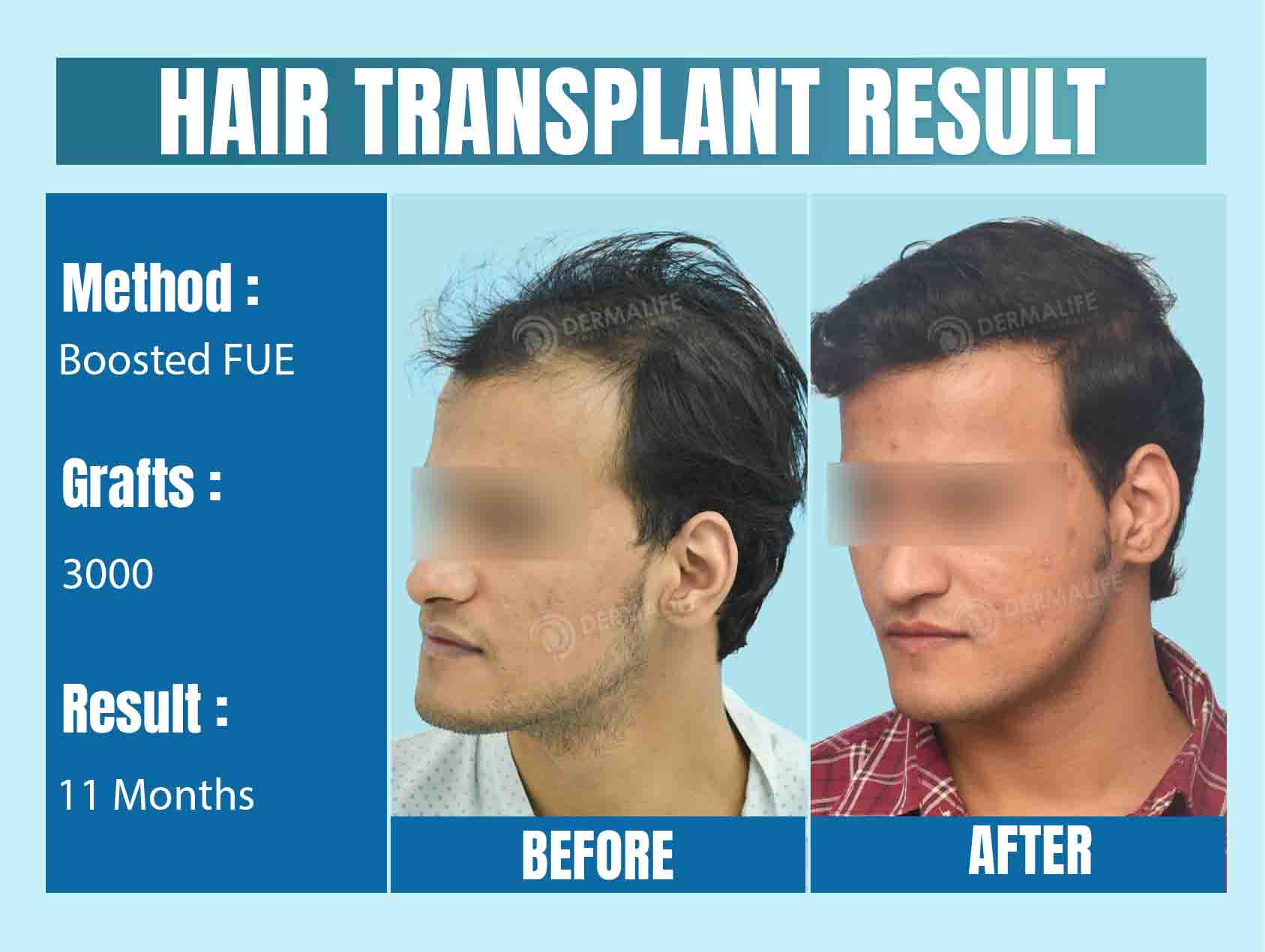 Best hair transplant clinic in Delhi 