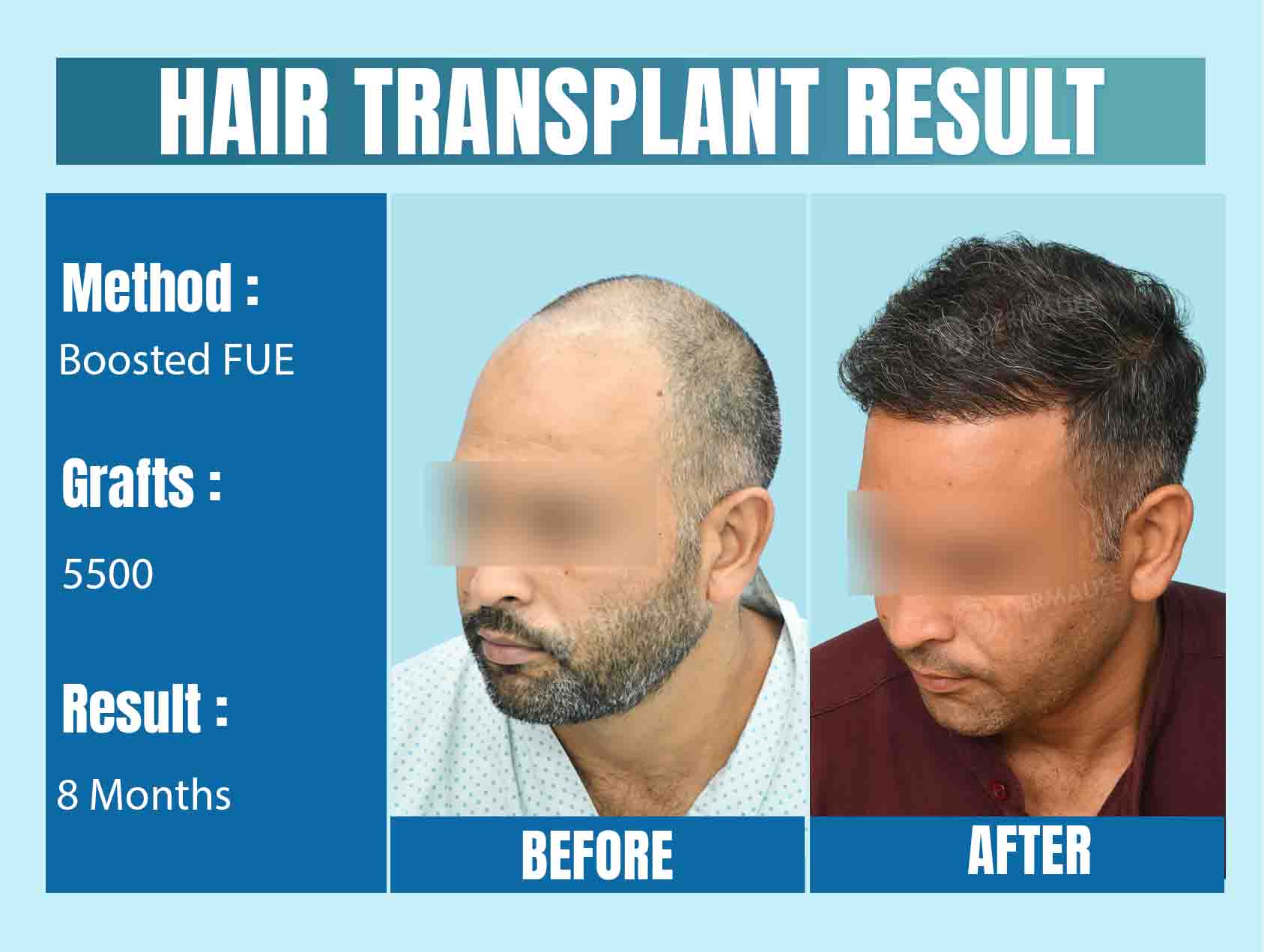 Best Hair Transplant Cost in Delhi