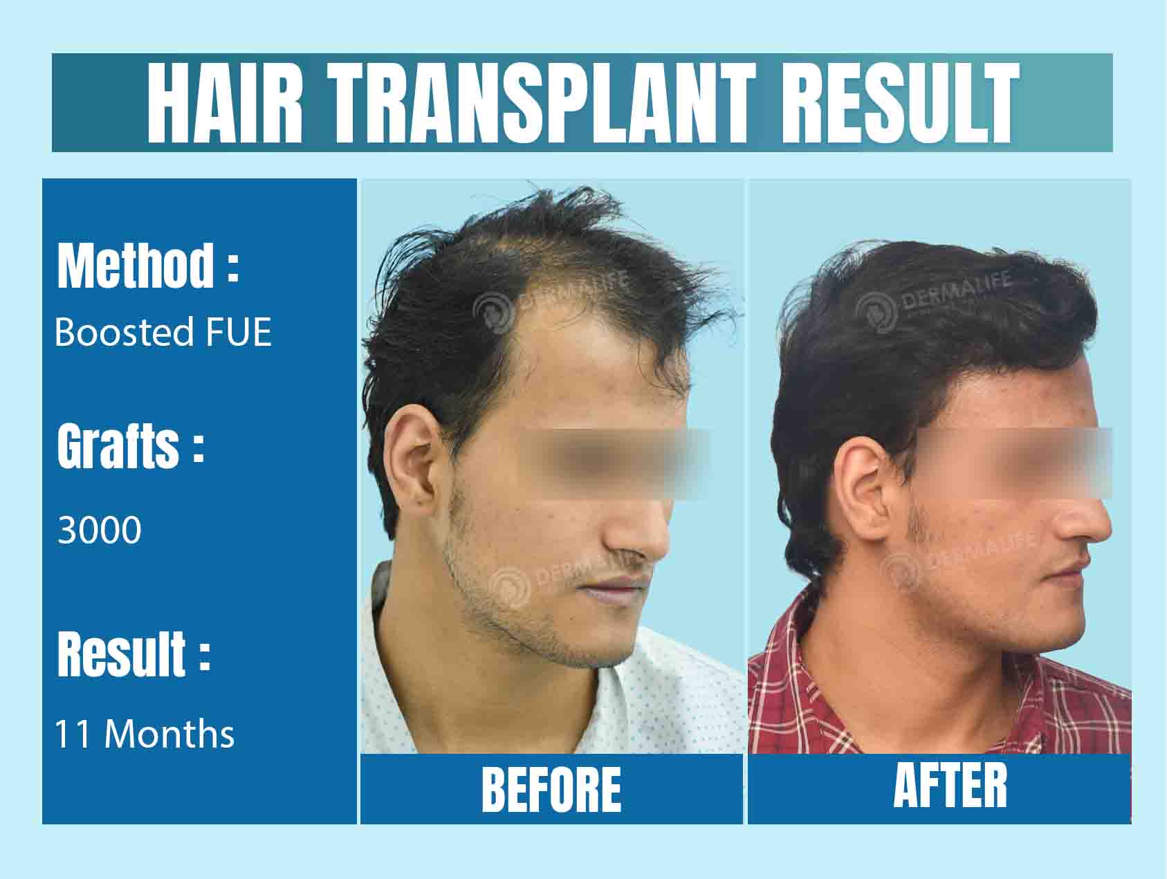 Best hair transplant clinic in Delhi 