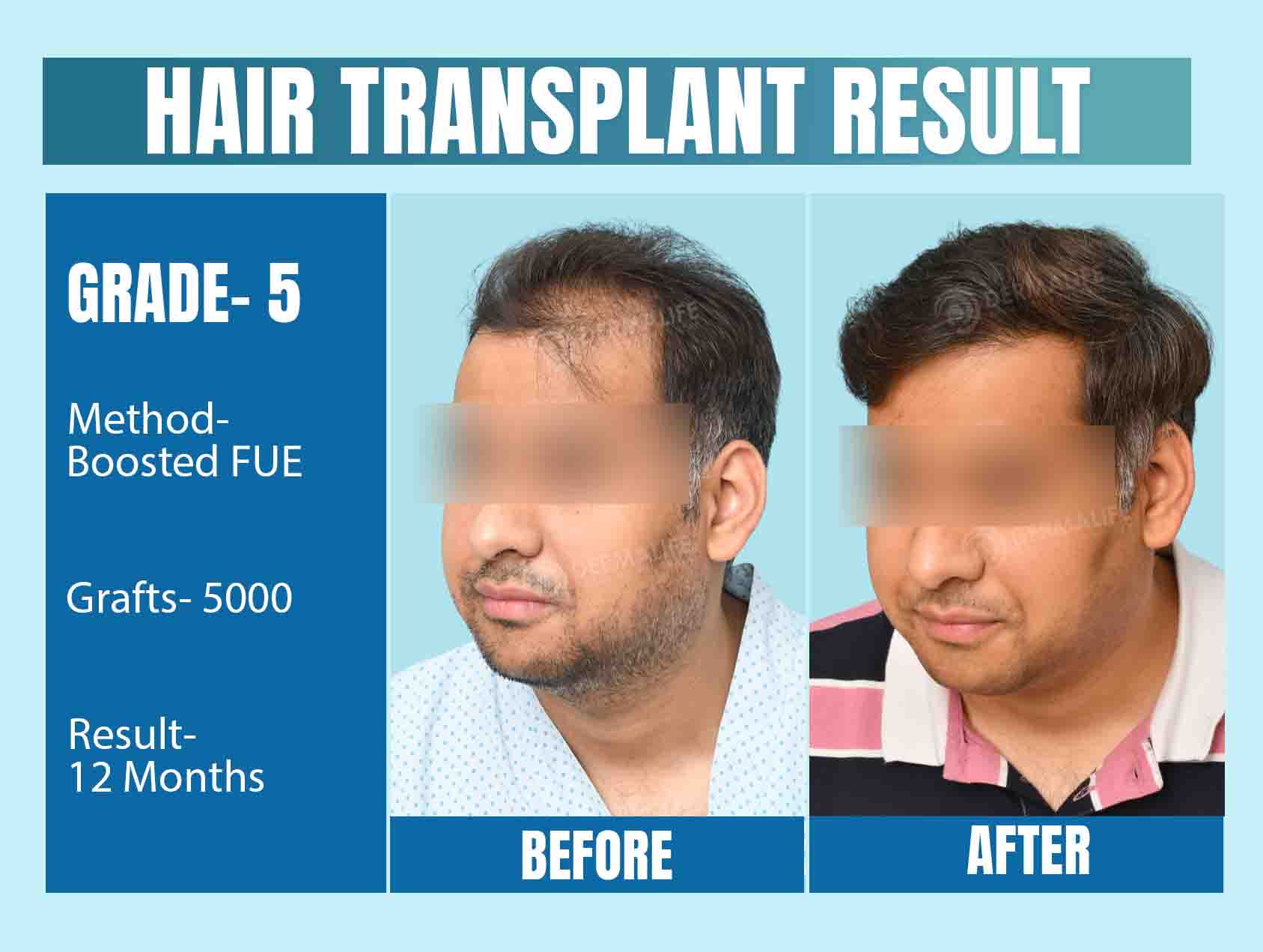 Hair Transplant Results After 12 Months 5000 Grafts with Boosted FUE Technique