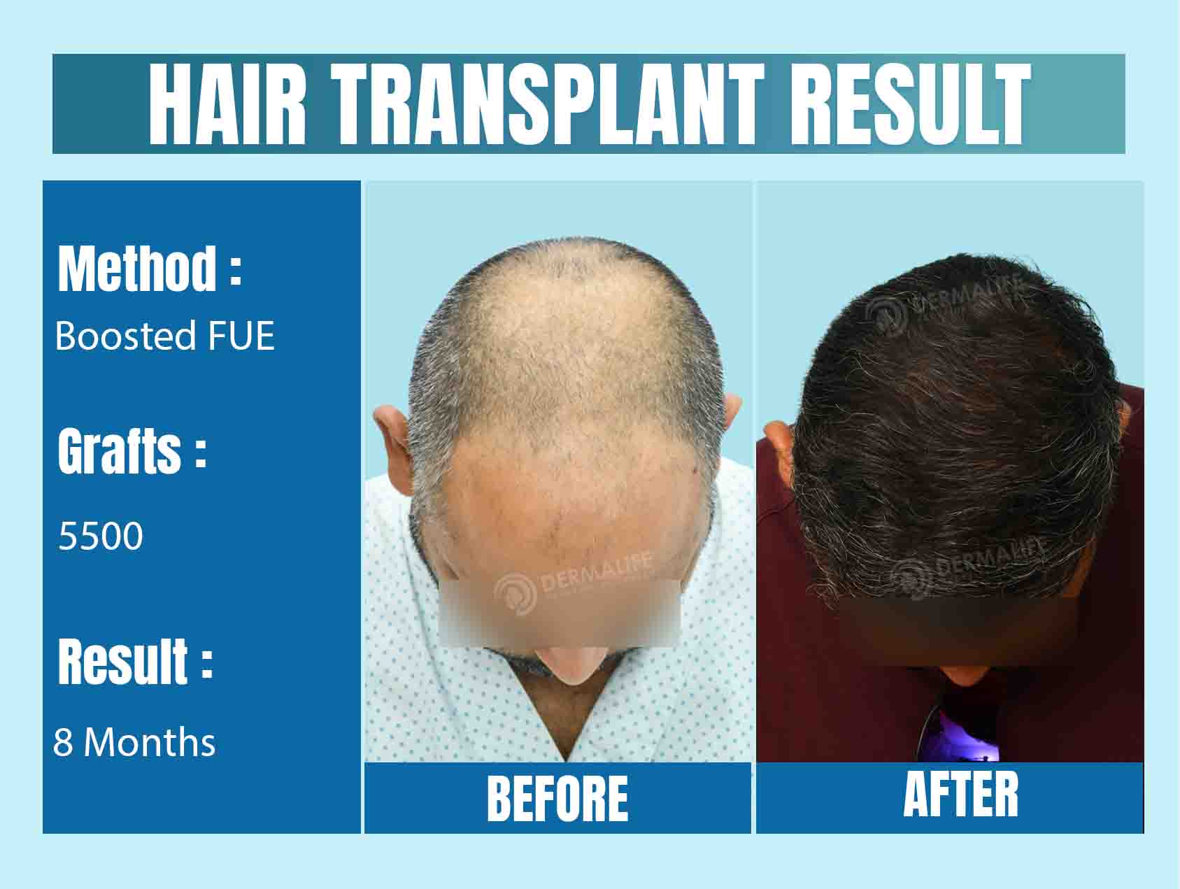 Best Hair Transplant Cost in Delhi