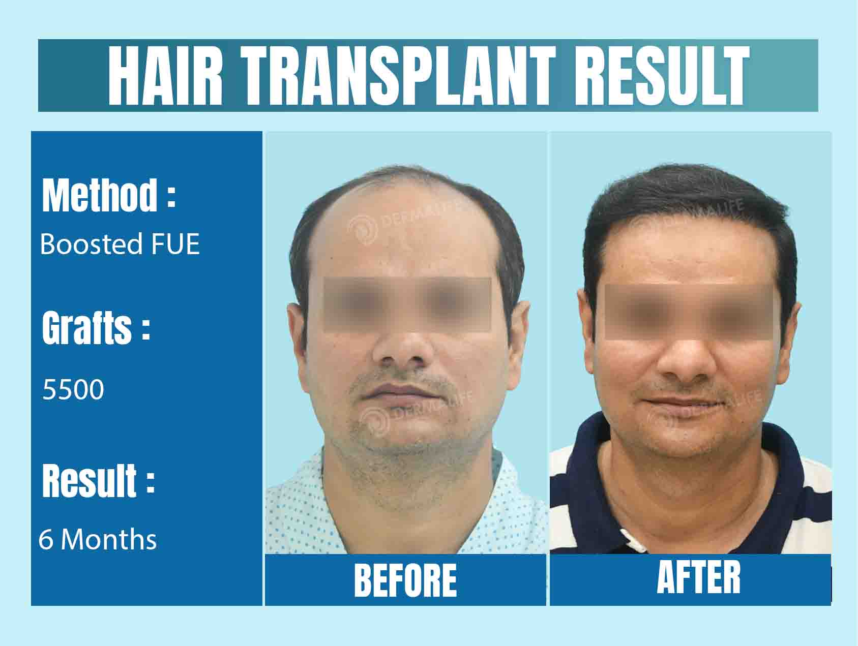 Top Hair Transplant Clinic in Delhi
