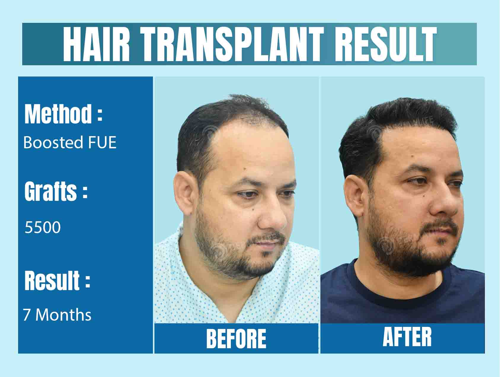Best Hair Transplant Clinic in India