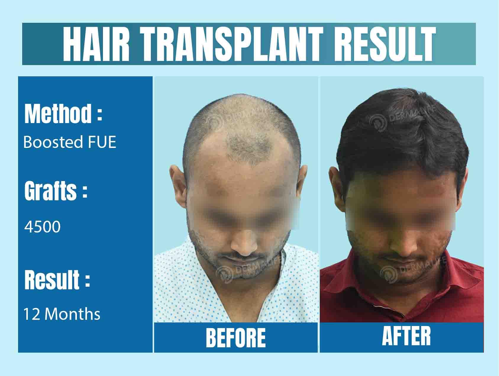 Top Hair Transplant Cost in Delhi NCR