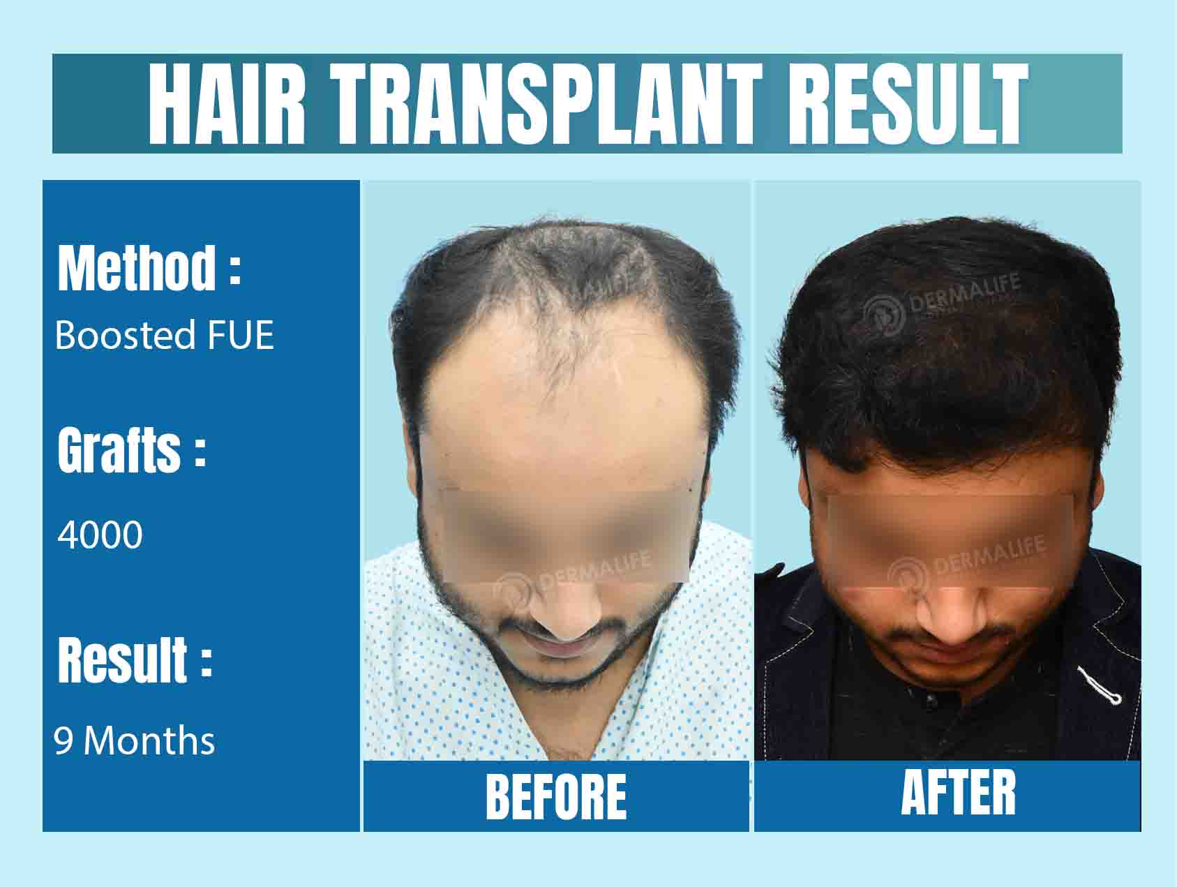 Hair Transplant Cost in Noida