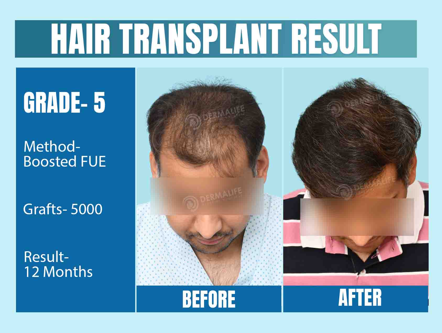 Hair Transplant Results After 12 Months 5000 Grafts with Boosted FUE Technique