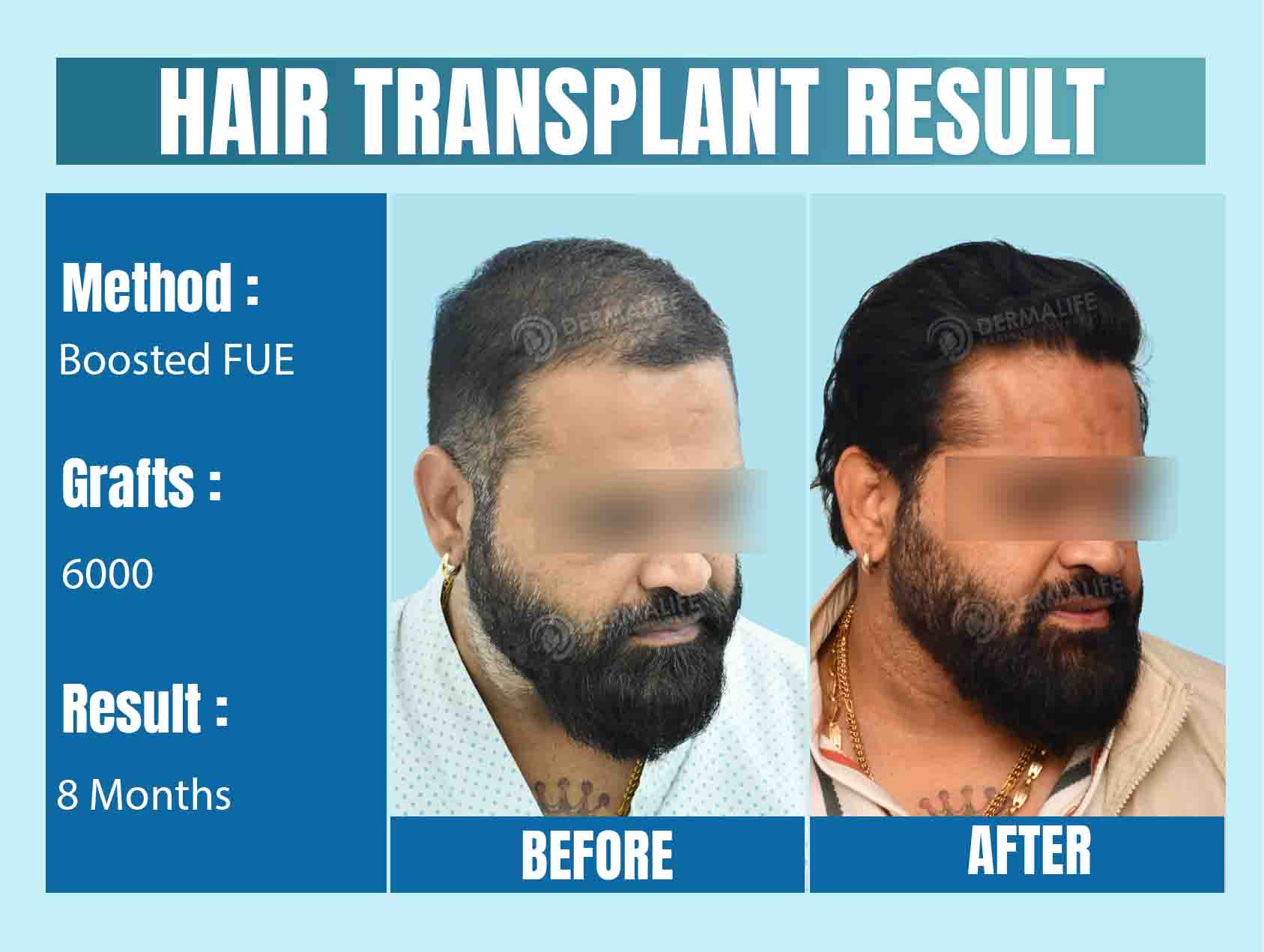 Top Hair Transplant Surgeon in Delhi