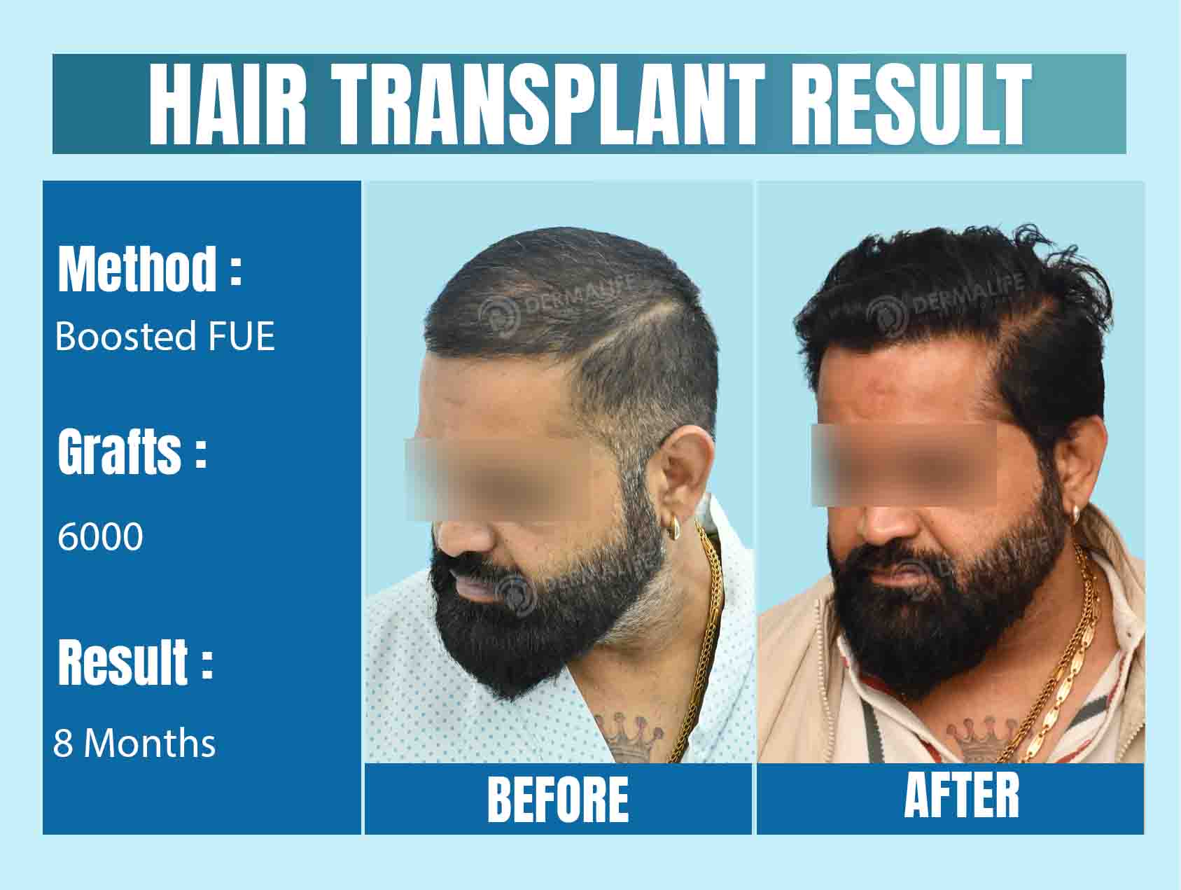 Top Hair Transplant Surgeon in Delhi