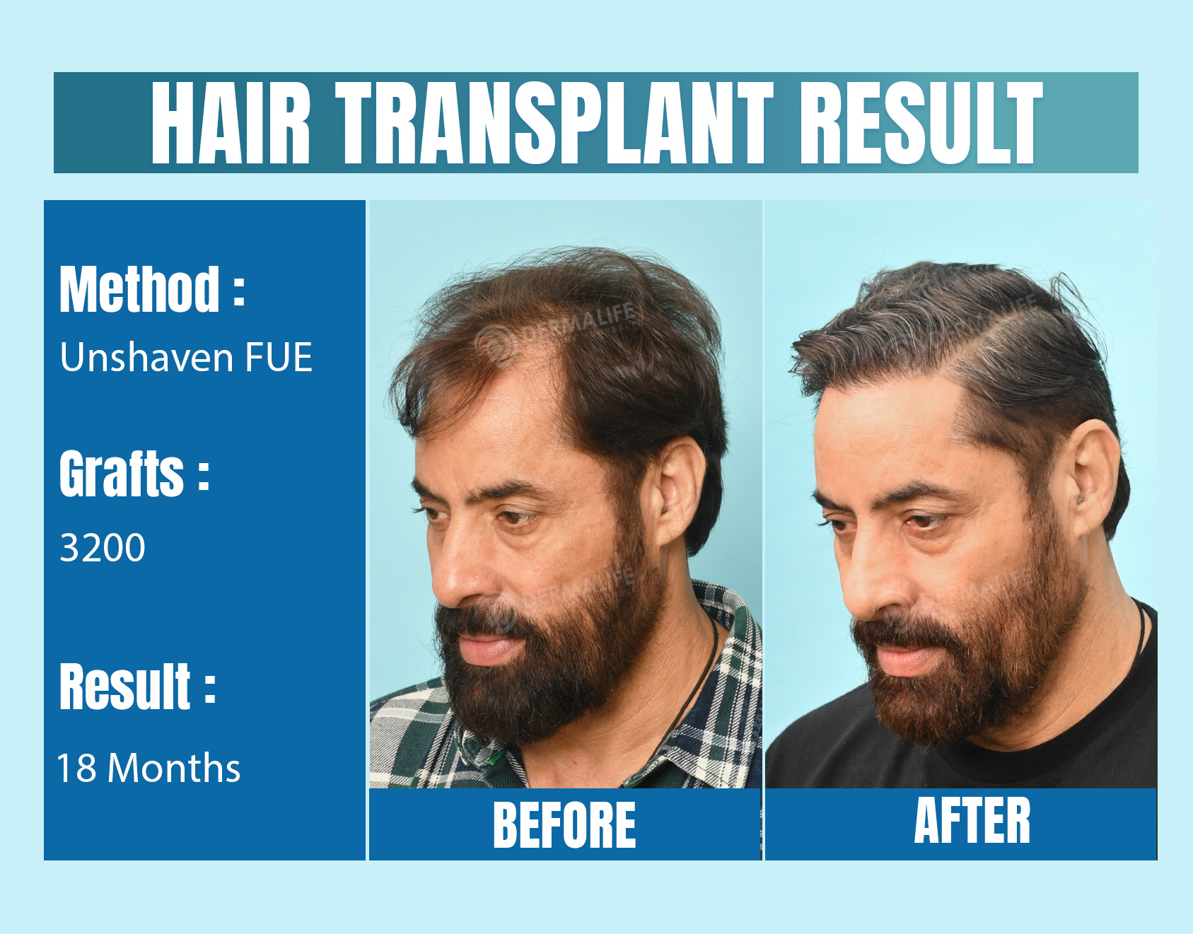 Unshaven FUE hair transplant cost in India