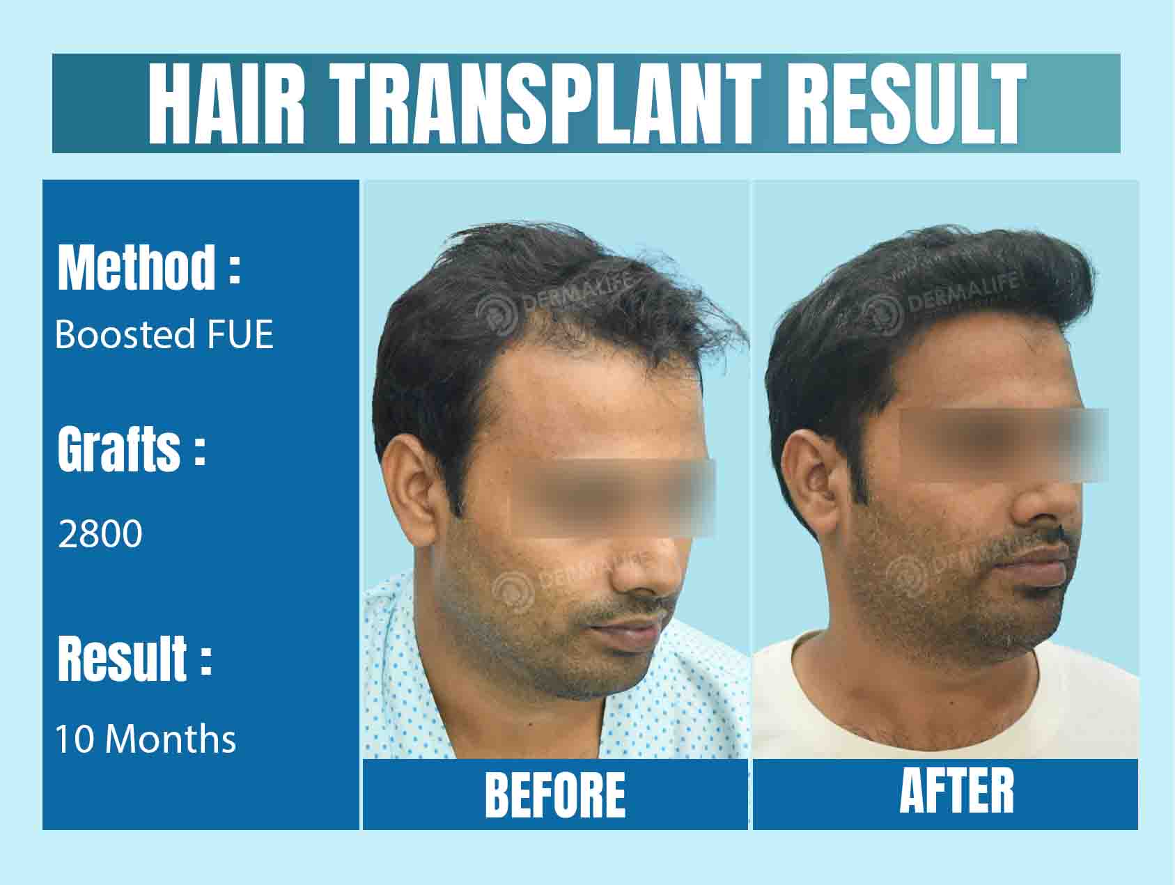 What are the Best Countries for Hair Transplant Surgery