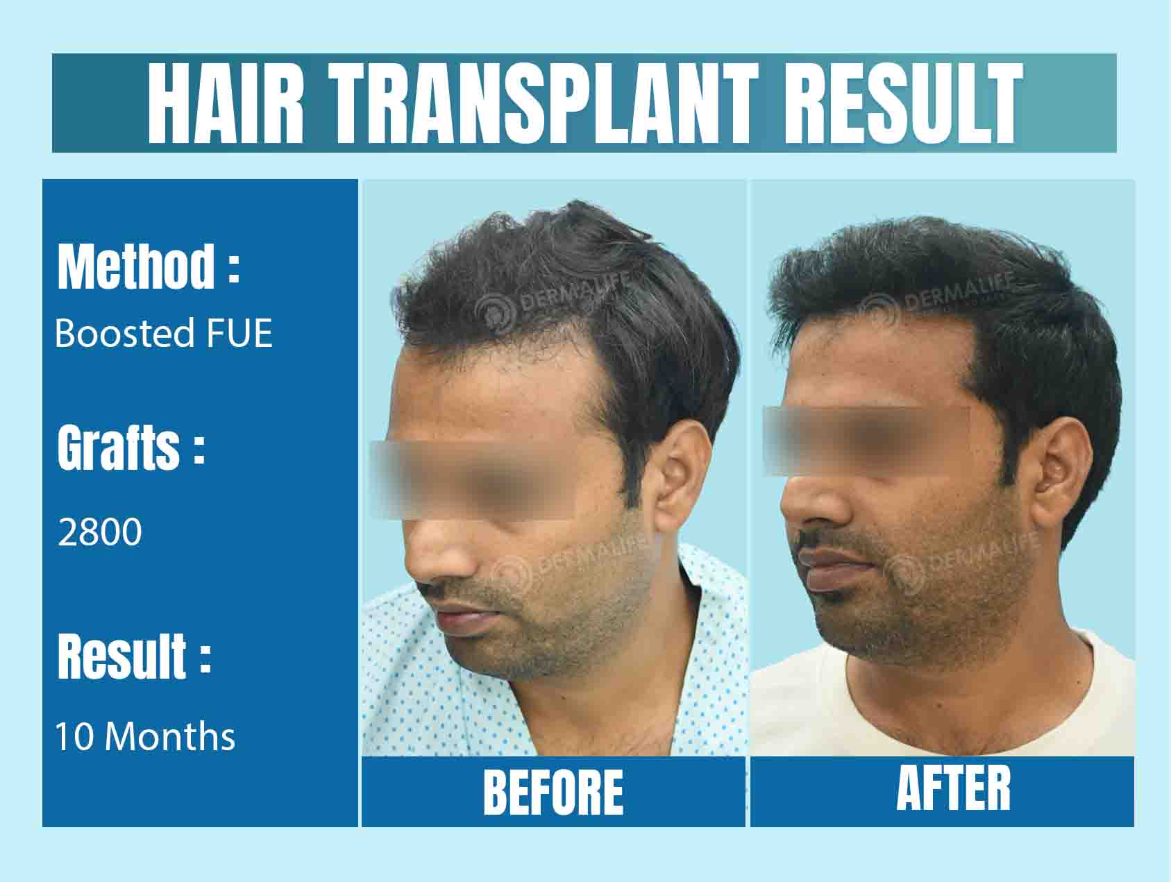 What are the Best Countries for Hair Transplant Surgery