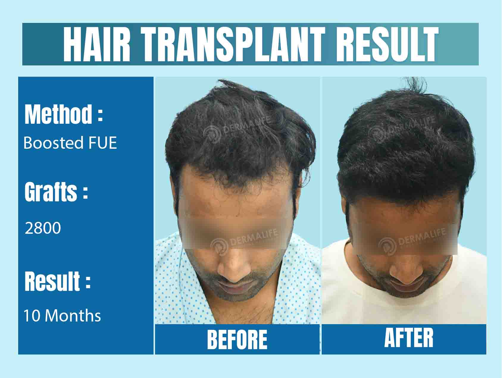 What are the Best Countries for Hair Transplant Surgery