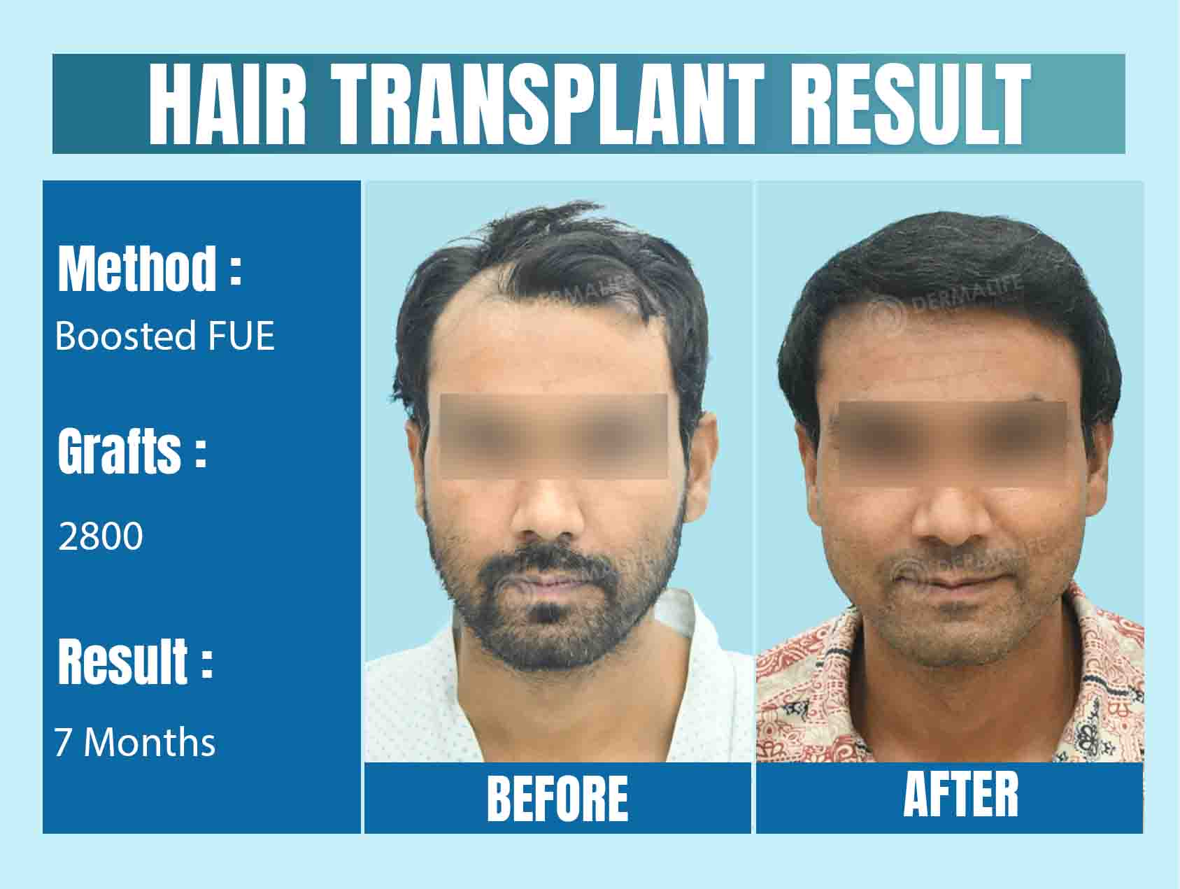 hair Transplant Before & After