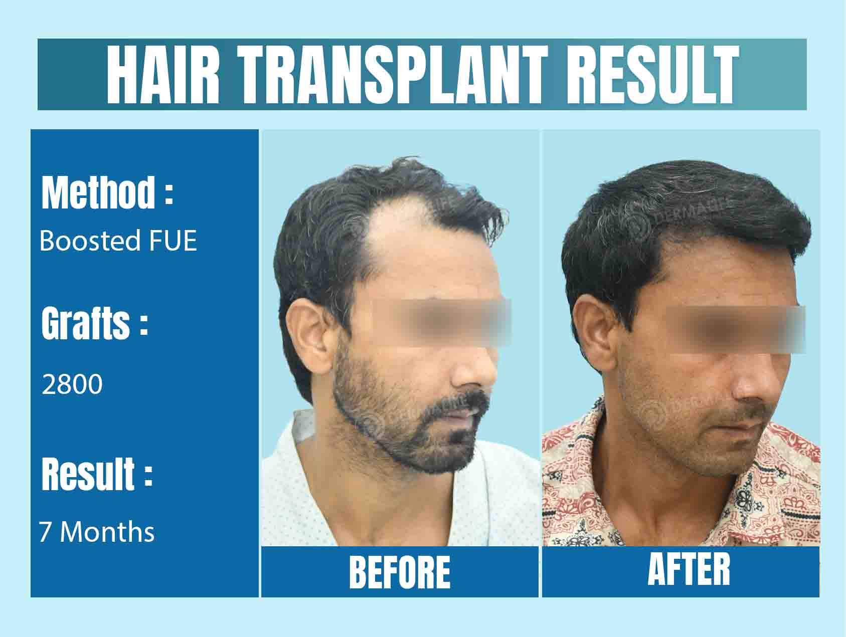 World's Best Hair Transplant Surgeon Result